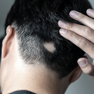 Alopecia Areata