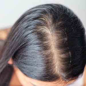 Alopecia relacionada con Tiroidismo